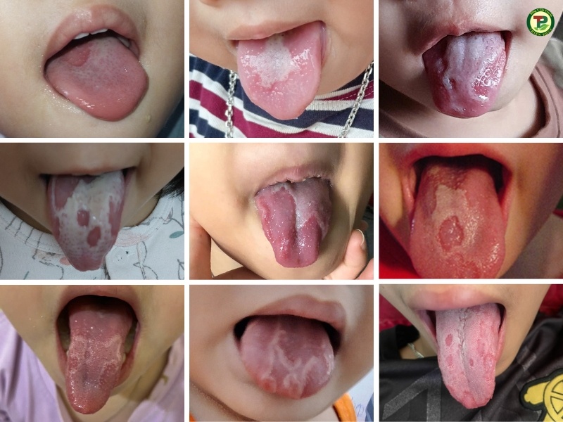 Nấm Lưỡi Ở Trẻ: Nguyên Nhân Và Cách Điều Trị